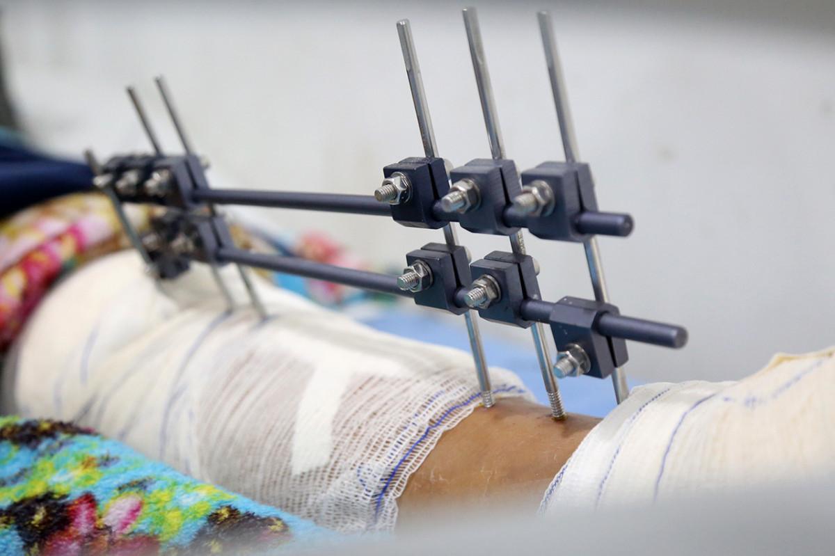 Acidentes com motos crecem no semestre e ligam alerta em hospital refer&ecirc;ncia da regi&atilde;o
