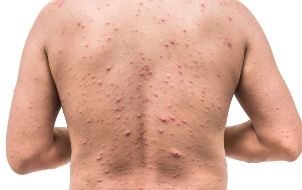 Herpes-z&oacute;ster pode atingir uma em cada tr&ecirc;s pessoas e &eacute; mais comum ap&oacute;s os 50 anos